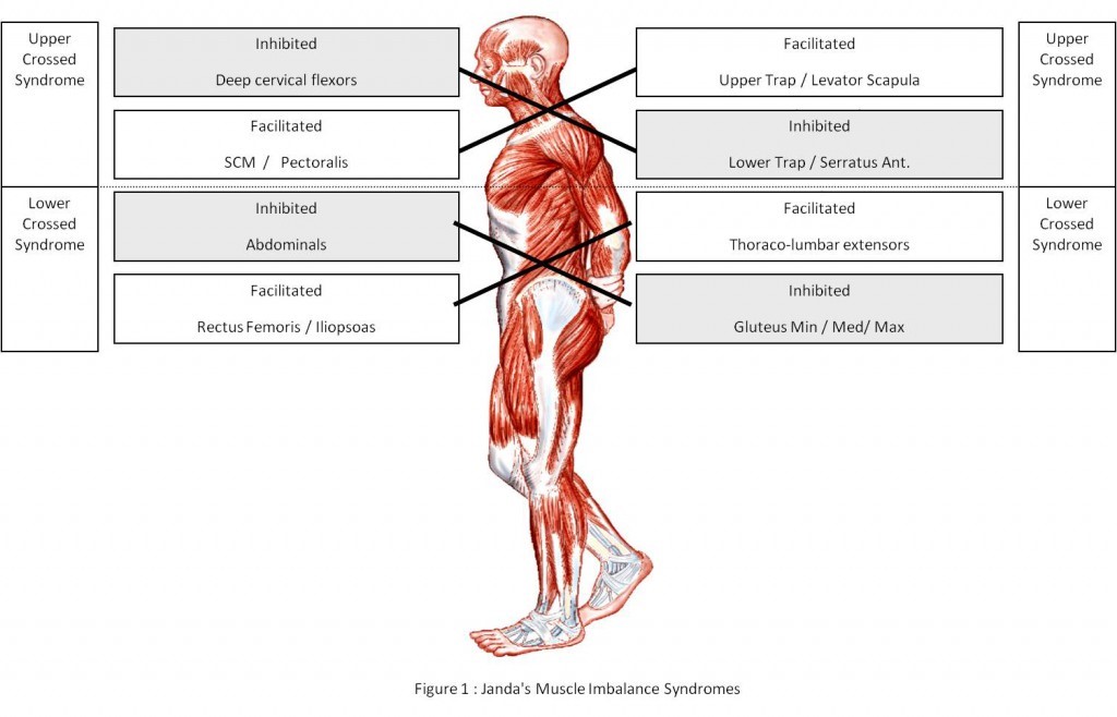 Upper and Lower Crossed Syndromes in Hockey