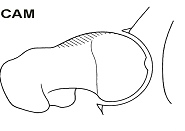 CAM Impingement