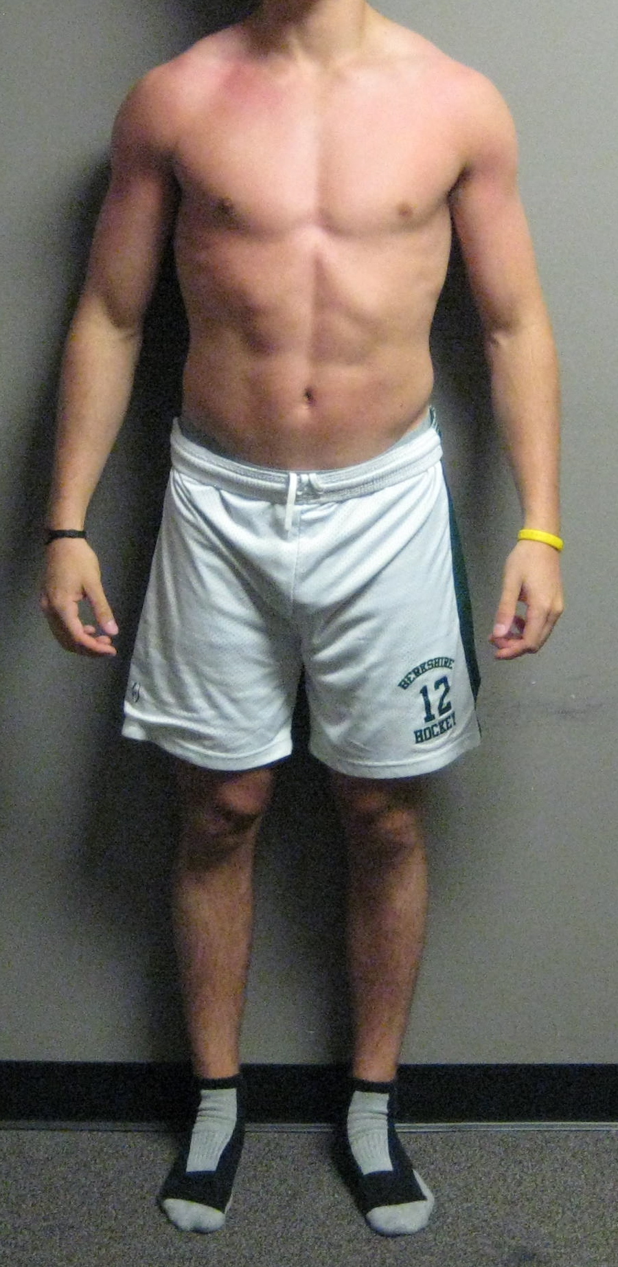 Open Scissors Posture-Anterior View