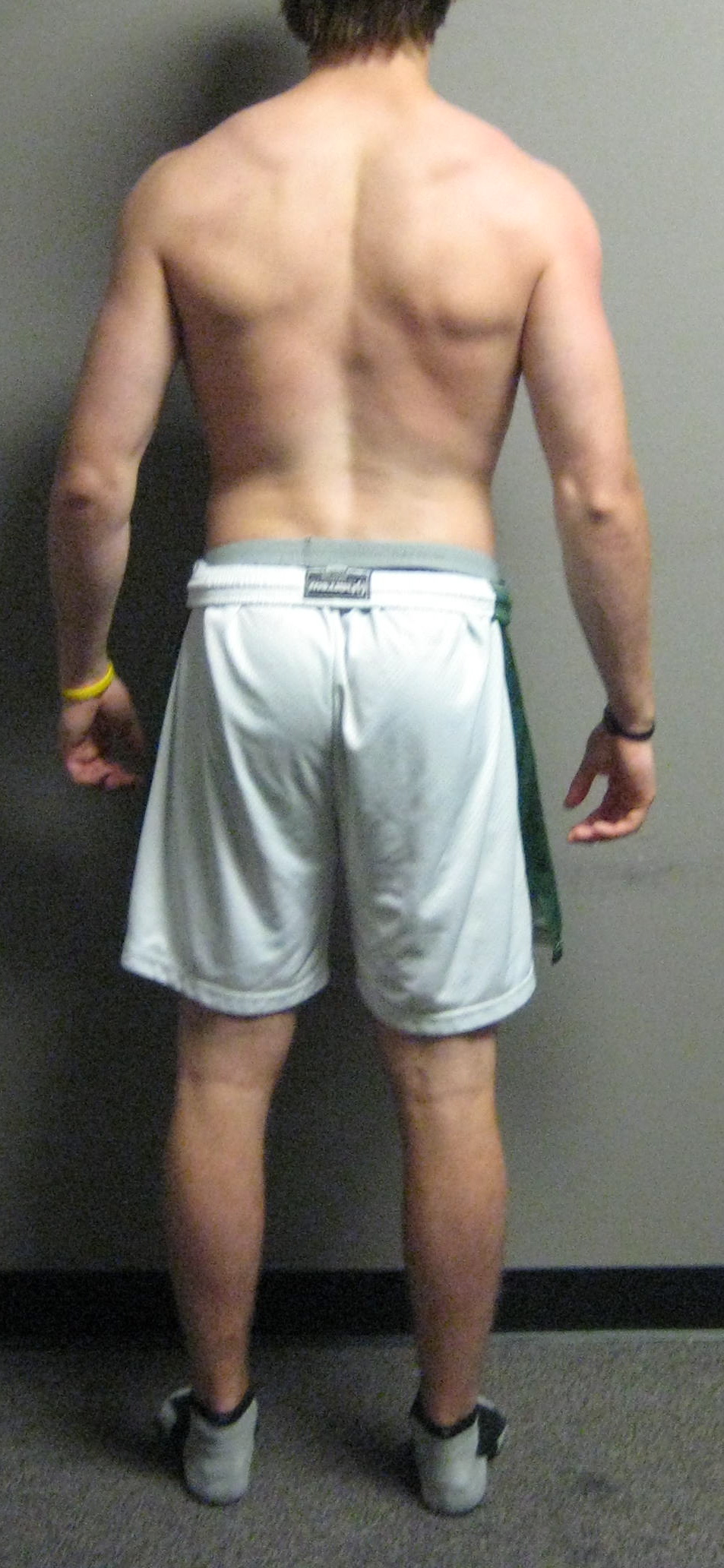 Open Scissors Posture-Posterior View