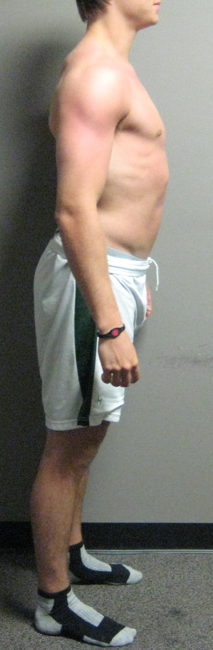 Open Scissors Posture-Lateral View